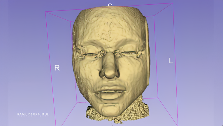 Snimka magnetske rezonancije pokazala što se događa s filerima u licu