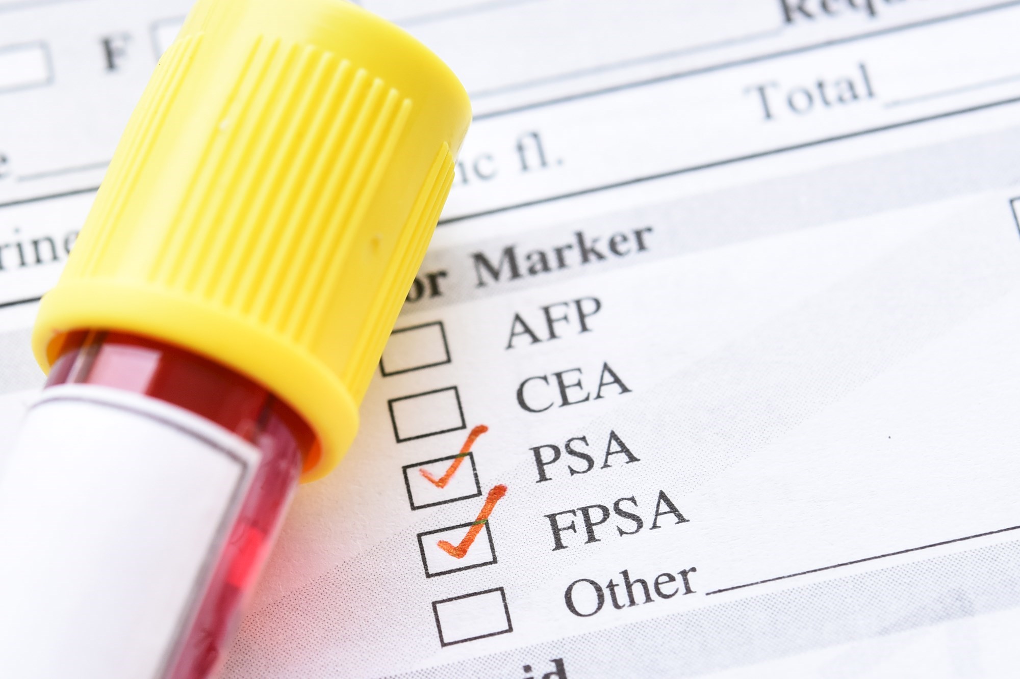 Jednostavan test otkriva rak prostate. 98% se izliječi ako ga otkriju na vrijeme