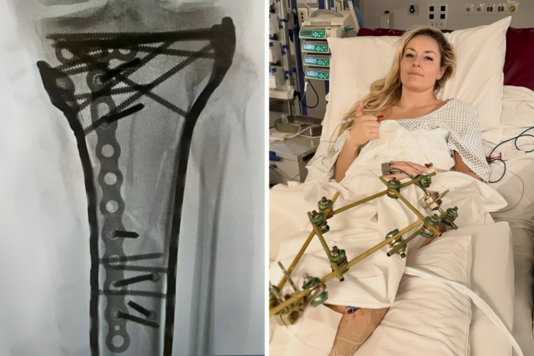 FOTO Vonn operirana šest sati. Objavila je rendgenske snimke noge pune šarafa