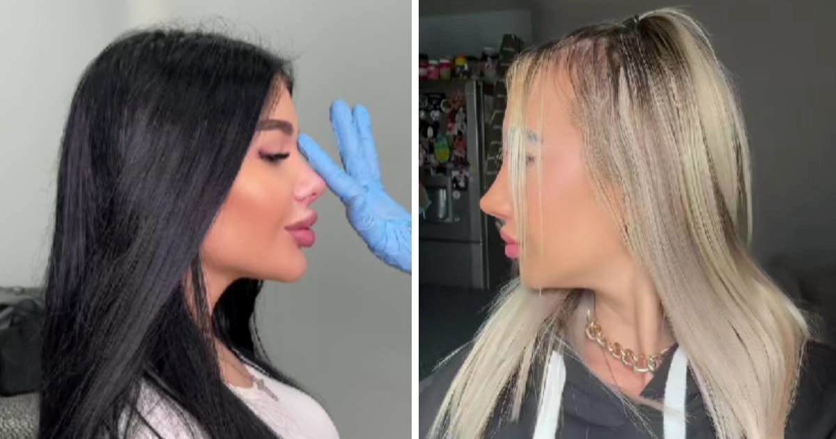 "Barbie nos" je novi hit u estetskoj kirurgiji. Liječnici upozoravaju na posljedice