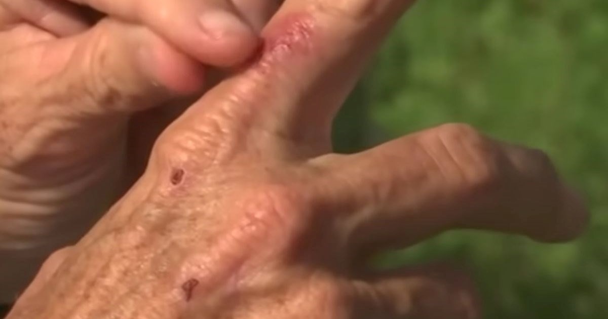 Američki liječnici: Najmanje četvero mrtvih na Floridi od bakterije koja jede meso