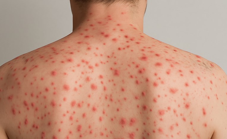 Beč bilježi porast ospica i hepatitisa, vlasti izdale upozorenje