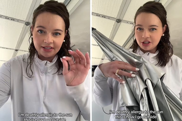 "Smrtno sam alergična na sunce": Pokazala kako izgleda njezin izlazak iz kuće