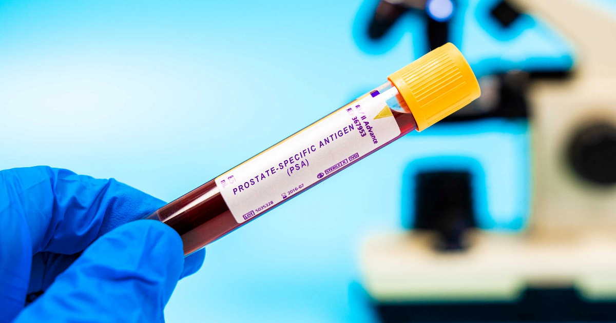 Testira se AI alat, mogao bi ubrzati dijagnozu raka prostate
