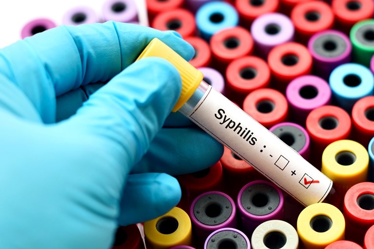 Sifilisa je sve više