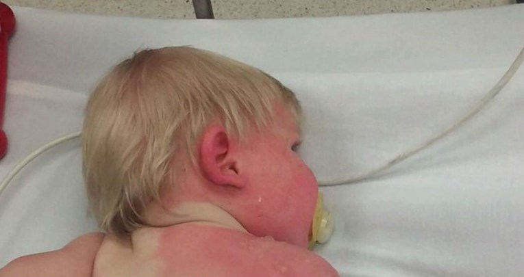 Fotografija djeteta s opeklinama po tijelu obilazi svijet i nosi važno upozorenje