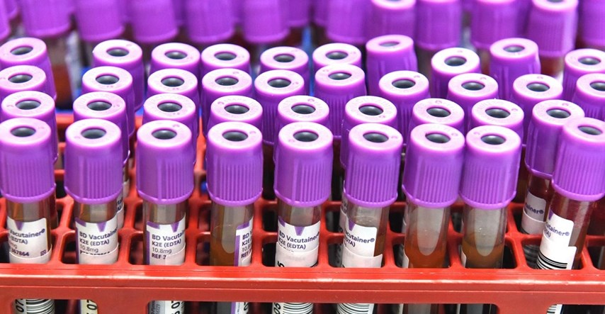 Znanstvenici u Australiji razvili krvnu pretragu za rano otkrivanje melanoma