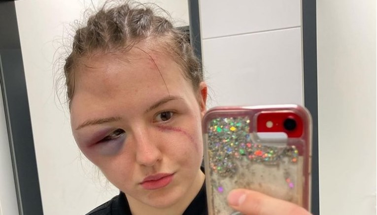 Boksačica pokazala kako joj izgleda lice nakon borbe koja je prekinuta zbog ozljede