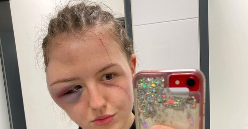 Boksačica pokazala kako joj izgleda lice nakon borbe koja je prekinuta zbog ozljede