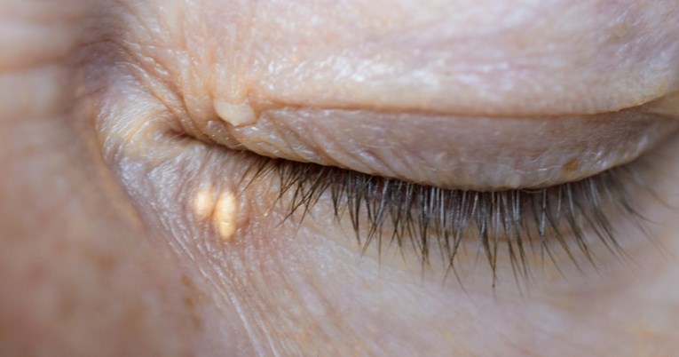 Kardiolozi: Neočekivana promjena kože povezana je sa srčanim bolestima