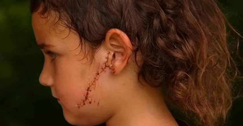 Pit bull napao dječaka u Australiji. Razderao mu lice. Operacija je trajala 3 sata