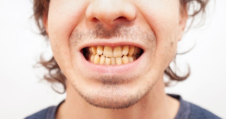 Stomatolog: Za ovu svakodnevnu naviku ni ne slutite da je loša za zube