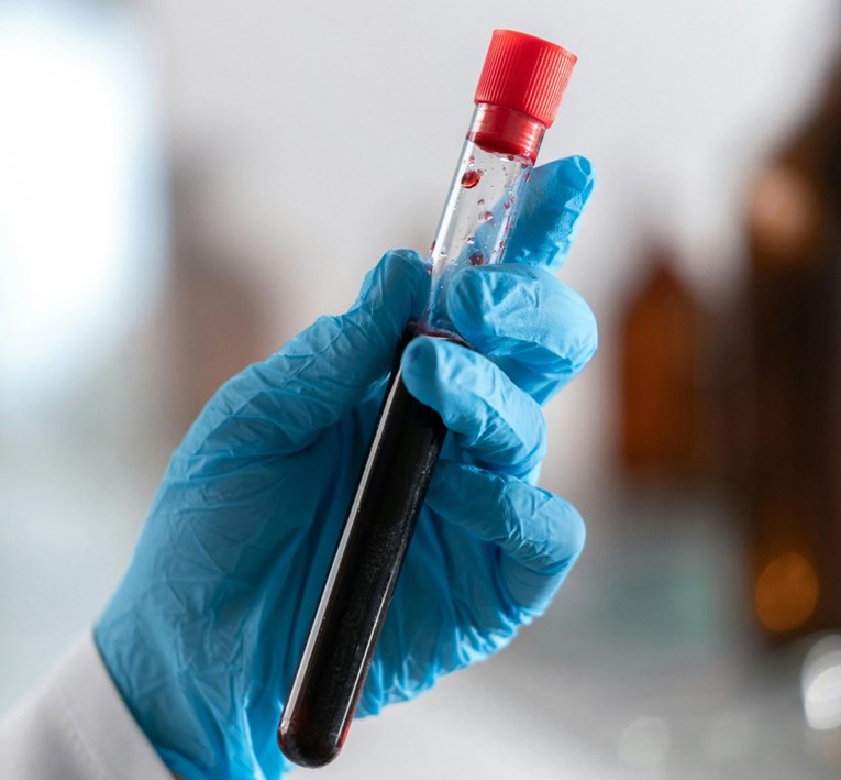 "Zlatna krv". Ovu krvnu grupu ima manje od 50 ljudi na svijetu