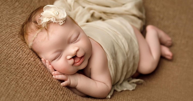 700 tisuća lajkova: Fotografija bebe rođene s rascjepom usne postala je viralna