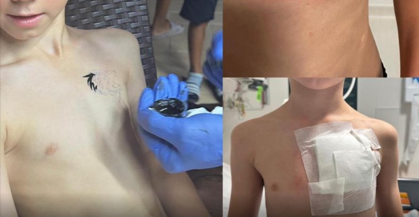 Devetogodišnjem dječaku privremena tetovaža spalila kožu: Zauvijek će imati ožiljak