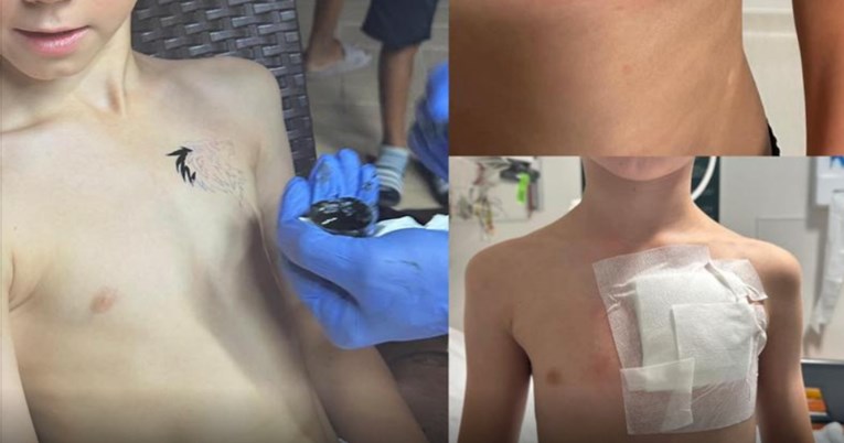 Devetogodišnjem dječaku privremena tetovaža spalila kožu: Zauvijek će imati ožiljak