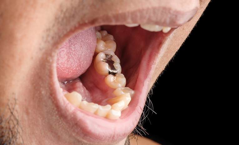 Hrvatska ukinula "crne plombe"