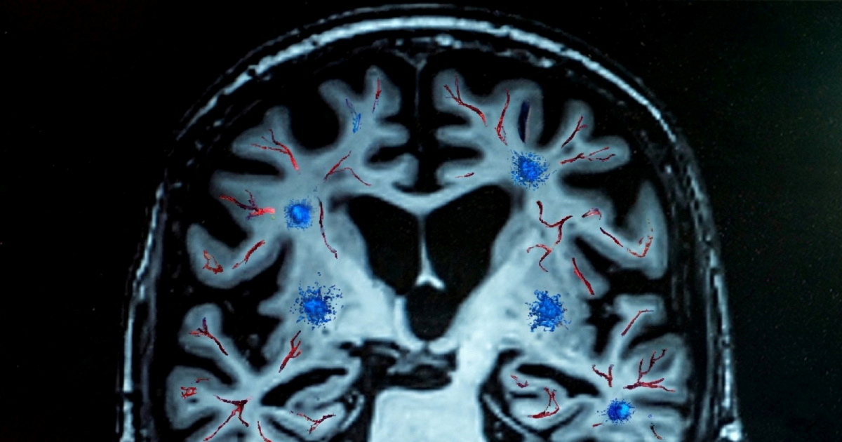 Otkriven gen odgovoran za većinu demencije i Alzheimera. Tko ga ima?