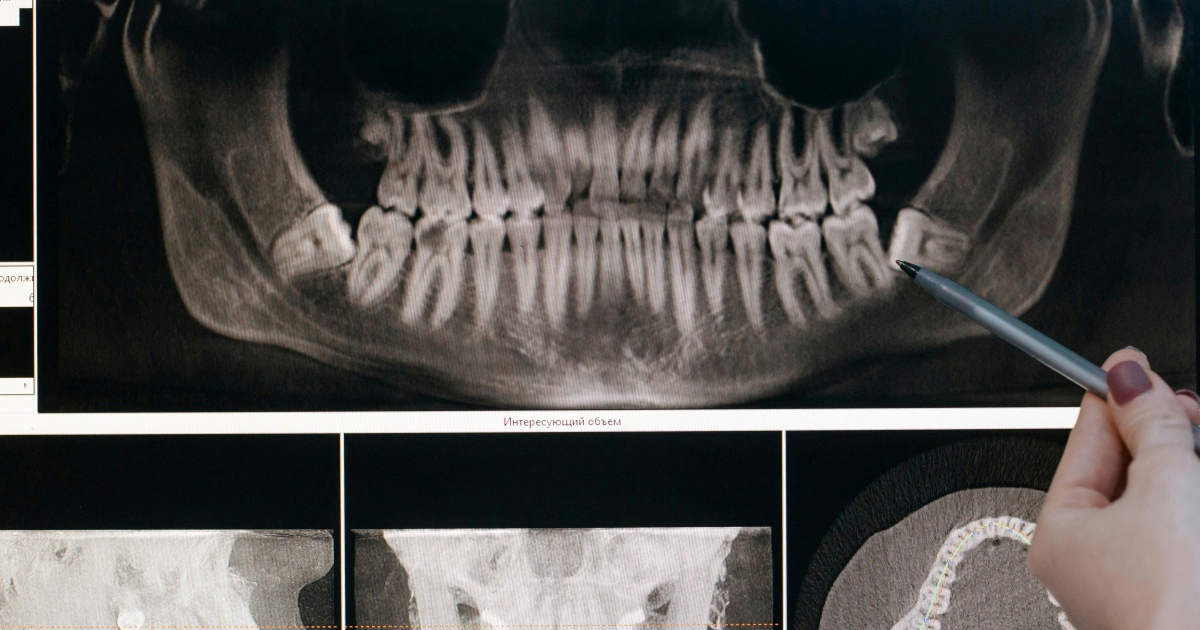 Nova studija: Gubitak zuba može biti znak ozbiljnih zdravstvenih problema