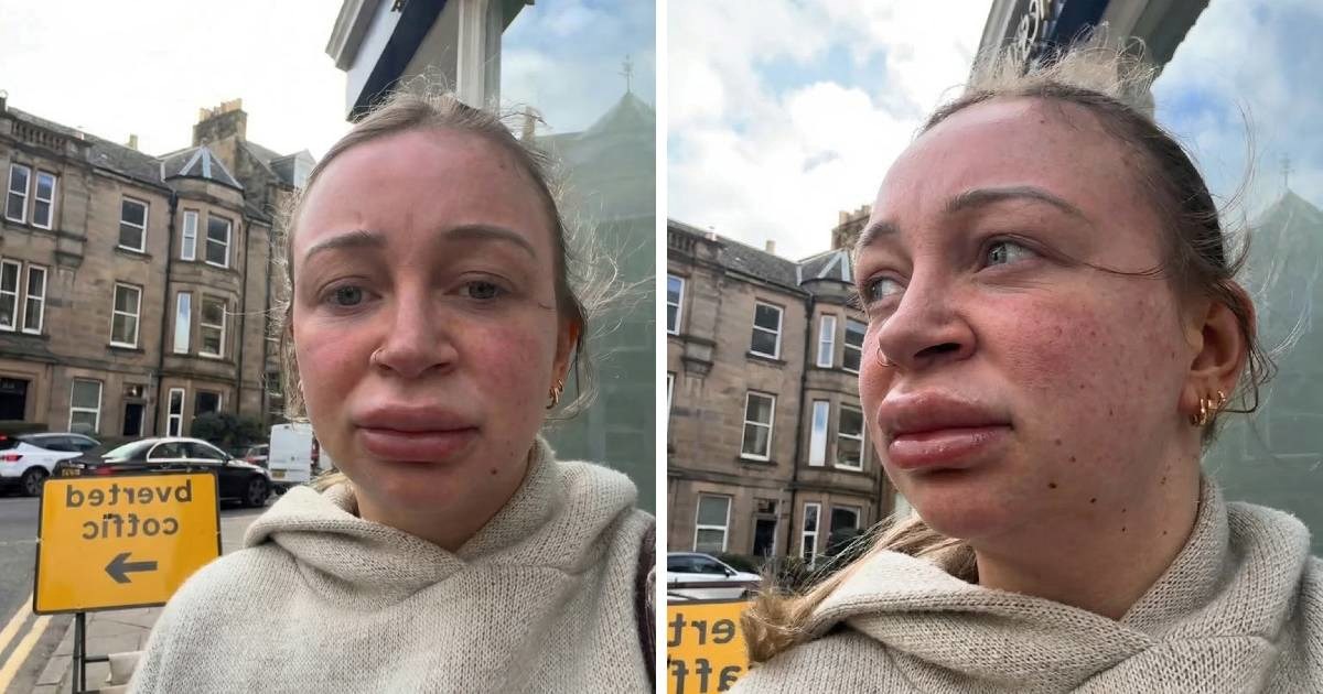 Otišla na otapanje filera u usnama pa pokazala reakciju, ljudi umiru od smijeha