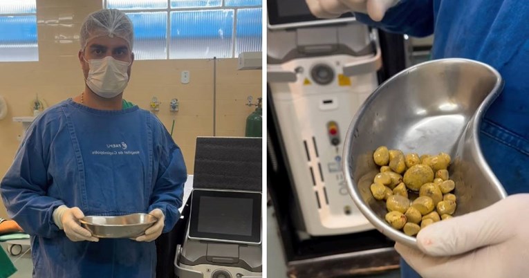 Tipu koji je svaki dan pio do tri litre gaziranog pića izvadili 35 bubrežnih kamenaca