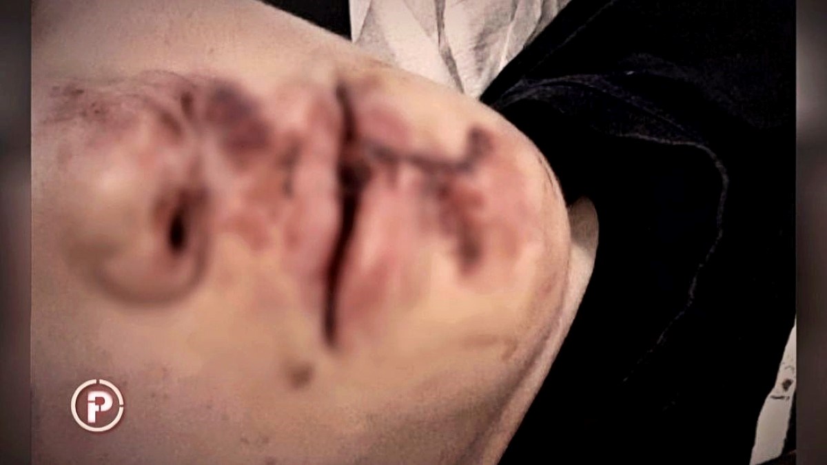 Dečko nađen u krvi na cesti u Puli. Policija: pao je s bicikla. Obitelj: Pretučen je