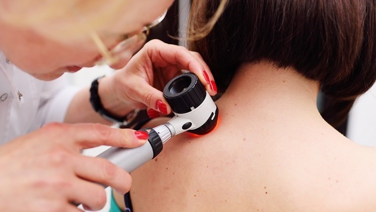 U akciji na Korčuli i Pelješcu utvrđena sumnja na 35 melanoma i 172 karcinoma kože