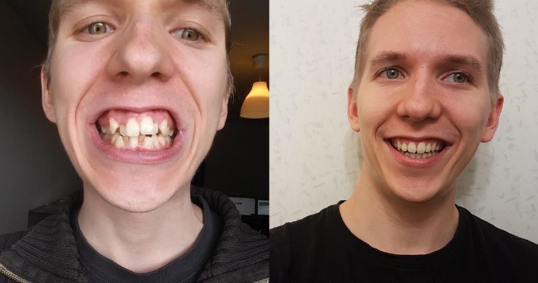 Ljudi pokazali koliko im je nošenje aparatića za zube transformiralo izgled