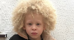 Petogodišnjak s albinizmom postao model za dječju odjeću