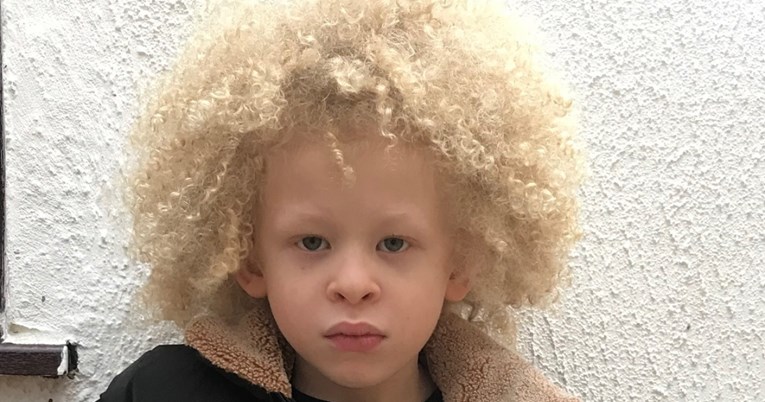 Petogodišnjak s albinizmom postao model za dječju odjeću