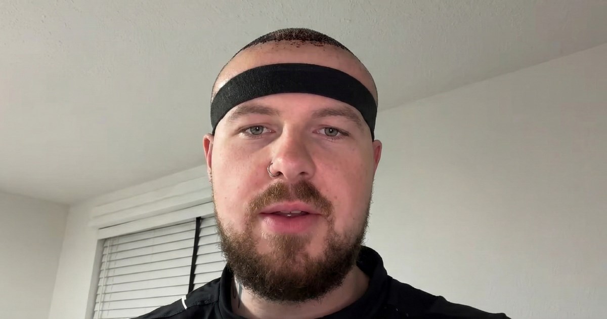 Brijač pokazao kako izgleda oporavak od transplantacije kose i - jao