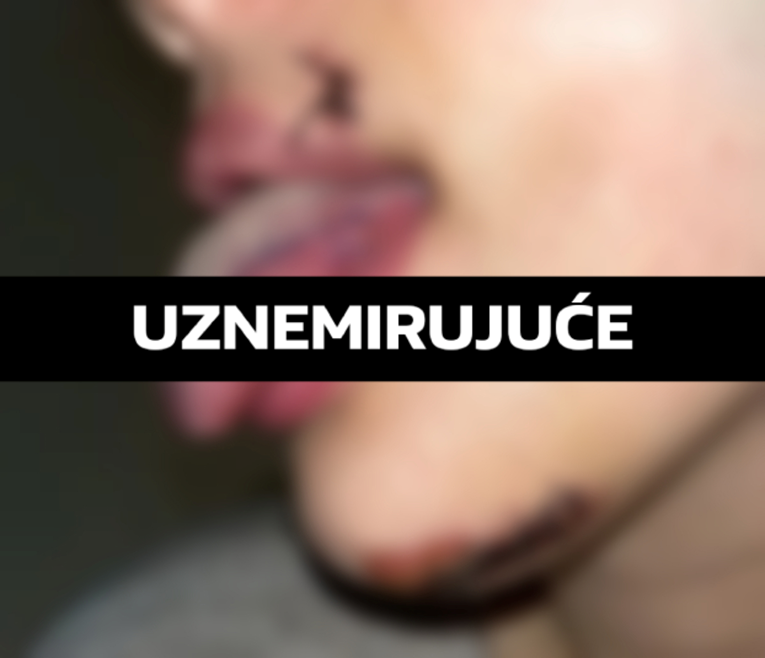 FOTO Hrvati napadnuti ispred kluba u Srbiji. "Pogrešno su mi zašili jezik"