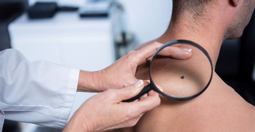 Studija: Ova svakodnevna loša navika može pomoći u ranom otkrivanju raka kože