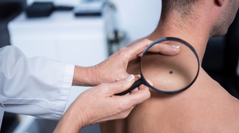 Ova svakodnevna loša navika može pomoći u ranom otkrivanju raka kože, otkriva studija