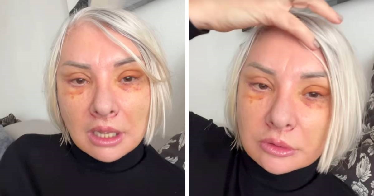 Danijela Dvornik skinula šavove i pokazala lice nekoliko dana nakon faceliftinga
