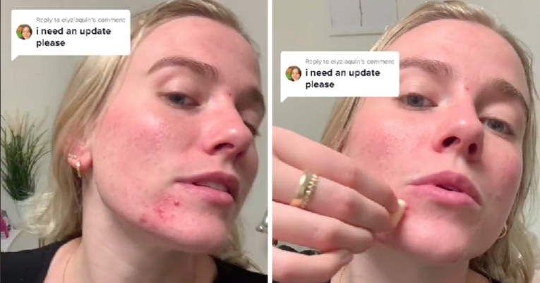 Beauty influenceri pokrenuli trend - mažu lice češnjakom. Javili se dermatolozi