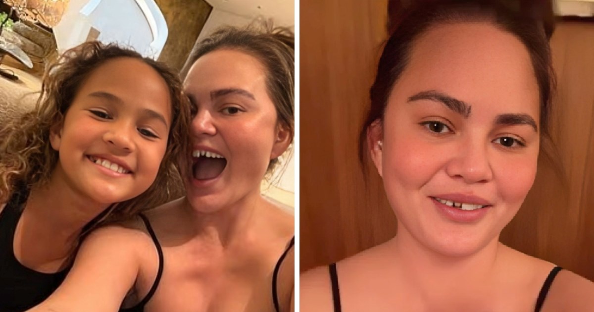 Chrissy Teigen ostala bez prednjeg zuba zbog božićnog slatkiša