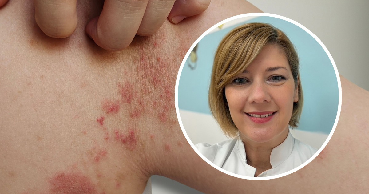 Splitska pedijatrica upozorava na slatke kraste: "Vrlo se brzo šire unutar obitelji"