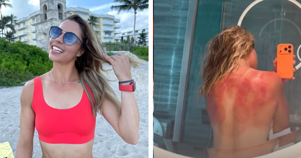 FOTO Meksička tenisačica izgorjela na suncu uoči Australian Opena: Ovo nije šala