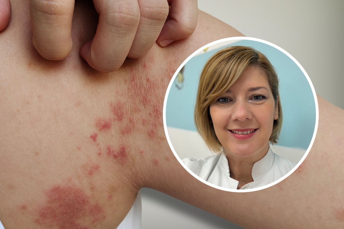 Splitska pedijatrica upozorava na slatke kraste: "Vrlo se brzo šire unutar obitelji"