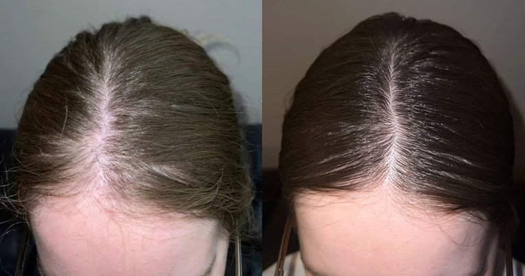 Ljudi oduševljeni rezultatima nakon korištenja ovog seruma za kosu
