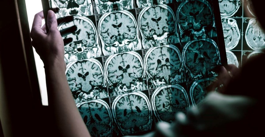 Ulazimo u novu eru liječenja Alzheimera? Novi lijek drastično usporava bolest