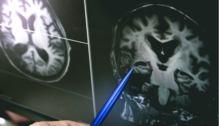 Povijesni trenutak u liječenju Alzheimera, novi lijek usporava razvoj bolesti