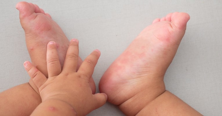 Što roditelji trebaju znati o bolesti šaka, stopala i usta