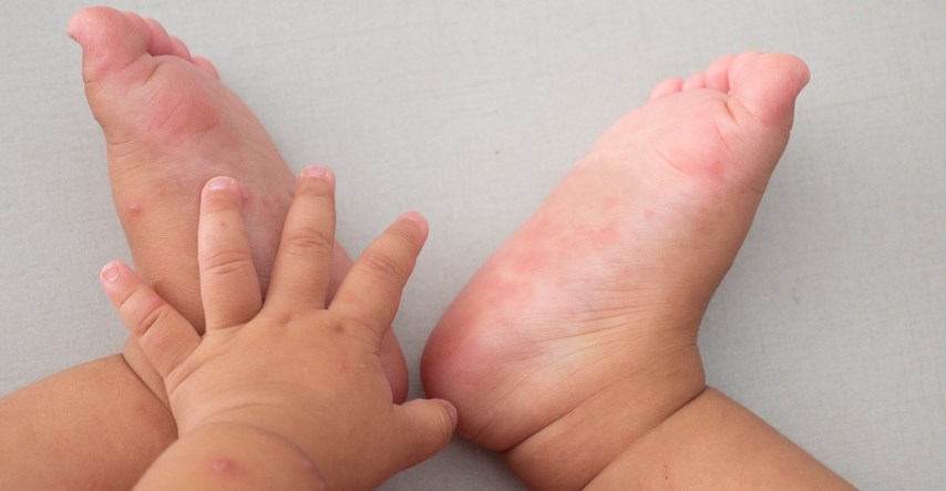 Što roditelji trebaju znati o bolesti šaka, stopala i usta