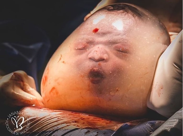 Beba se rodila u vrećici: "Plakala sam dok sam ga rađala"