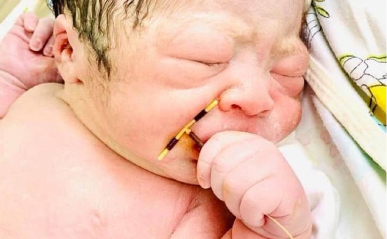 Ostala trudna usprkos kontracepciji - beba je rođena sa spiralom u ruci