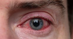 Tihi simptom Crohnove bolesti možete uočiti u očima