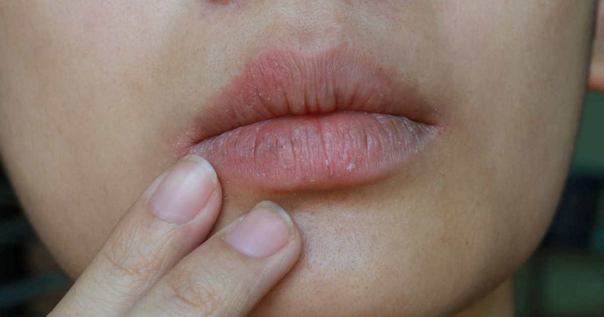 Dermatolog objasnio prave uzroke ispucalih usana zimi