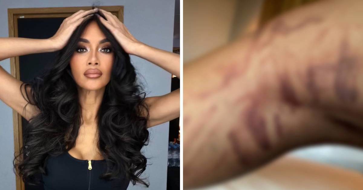 Nicole Scherzinger pokazala bolne opekline, ozlijedila se sat vremena prije nastupa